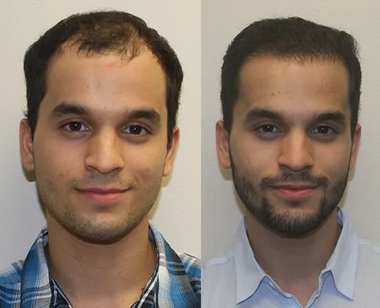 How Does Hair Restoration Work